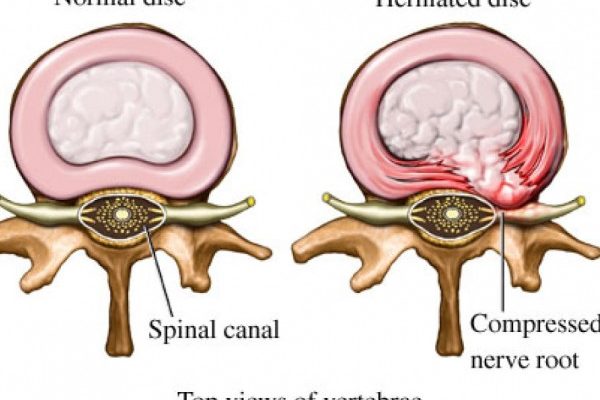 Sindromul dureros din hernia de disc lombara