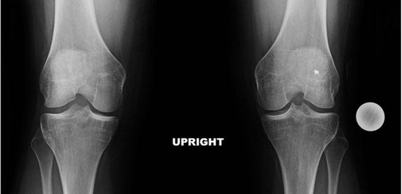 Gonartroză sau artroza de genunchi, cauza frecventă de prezentare la recuperare